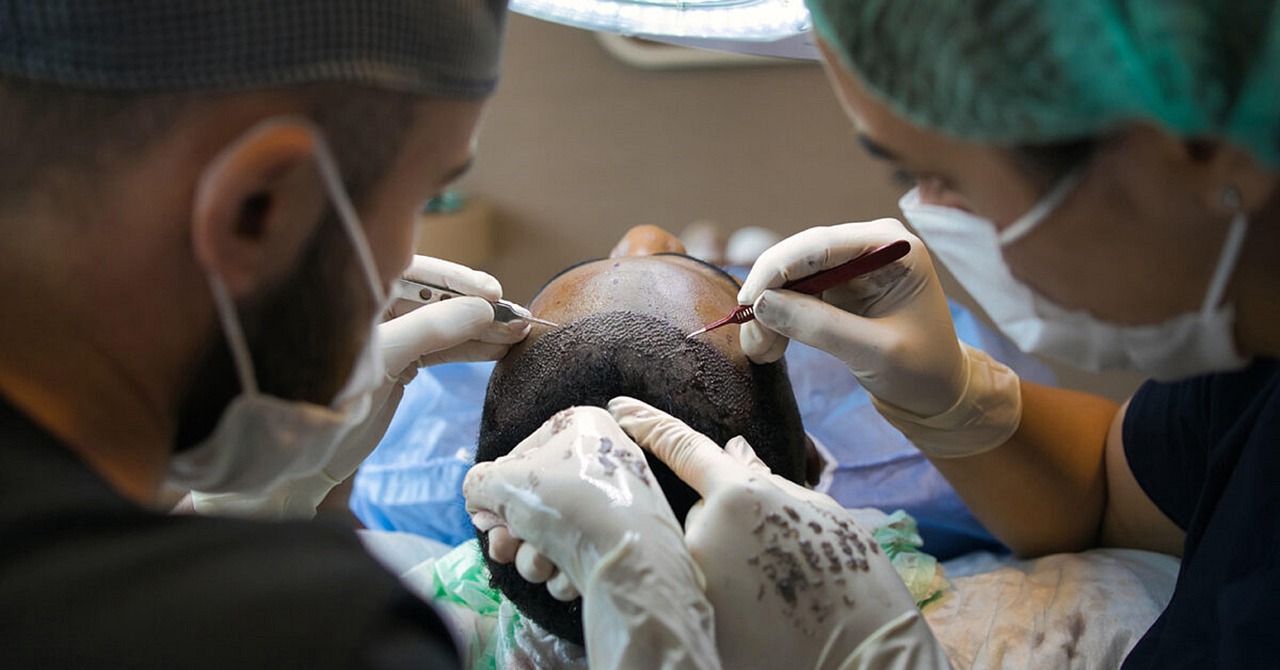 Cost vs Value: Why Turkey Has Become the Global Go-To for Hair Transplants